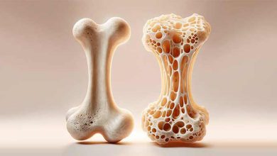 بمب تقویت استخوان در بزرگسالان