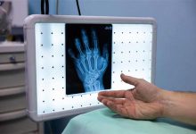 تشخیص پوکی استخوان با عکس رادیولوژی